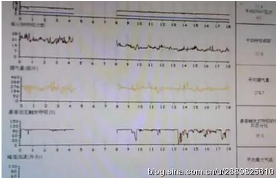 呼吸機使用一些常見問題